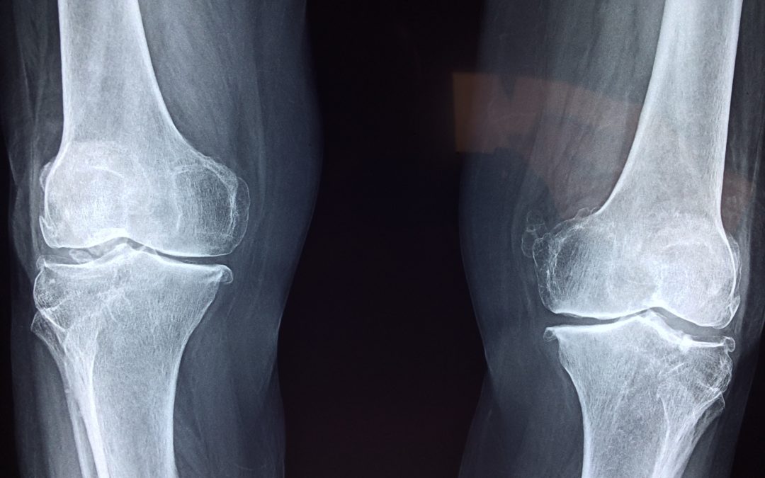 Kniearthrose🦵 – Einlage sorgt für Entlastung