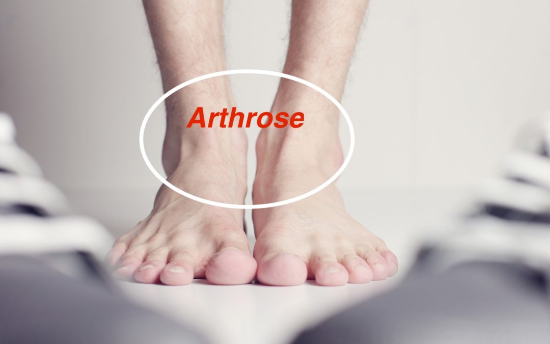 Arthrose im Sprunggelenk
