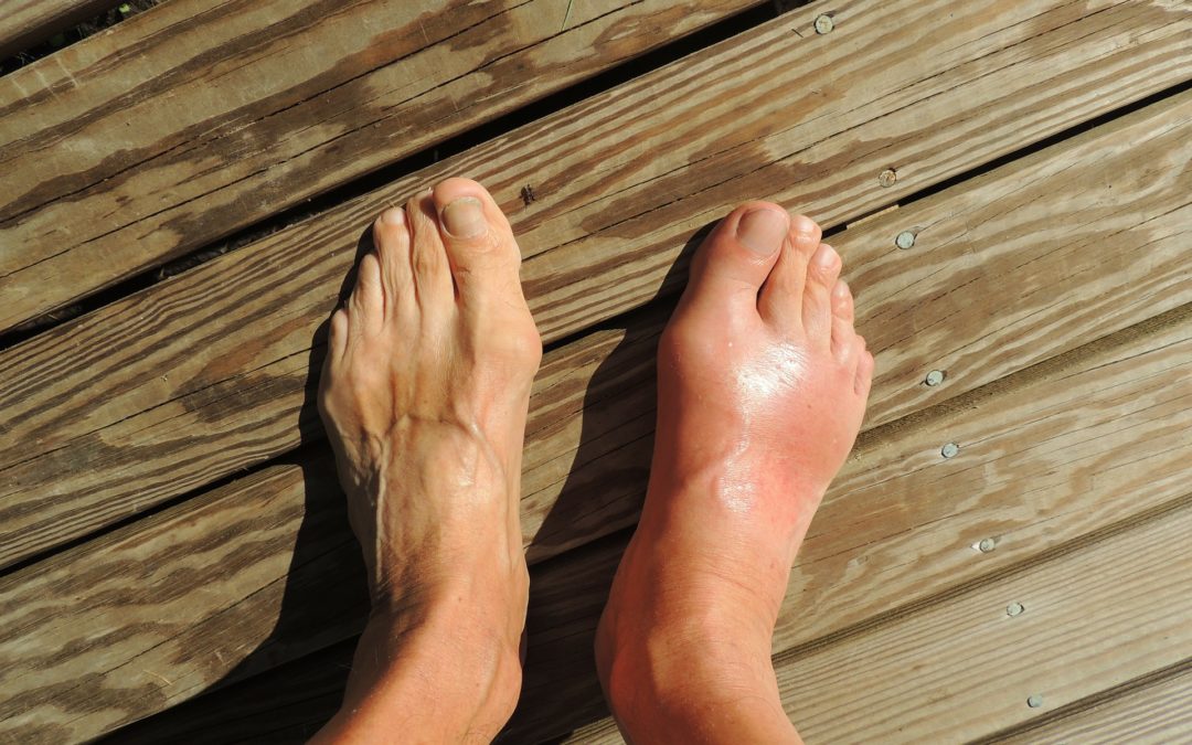 Hallux Valgus
